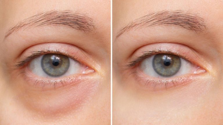 blefaroplastia-palpebra-inferior-olheira.jpg