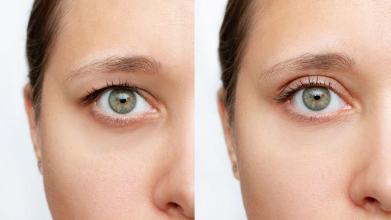 blefaroplastia-palpebra-superior.jpg